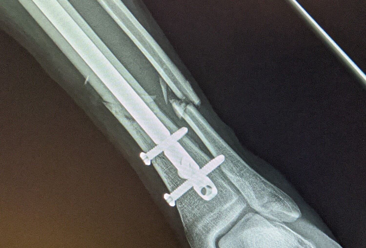 X-ray of an intramedullary nail in left tibia with a fractured fibula